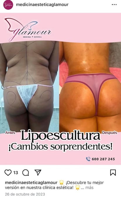 Anuncio de una cirugía en el perfil de Instagram de la clínica estética de Carabanchel en la que había un quirófano clandestino.